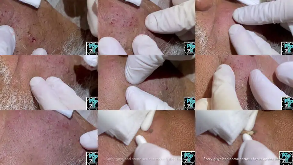 Favre-Racouchot syndrome. Multiple blackheads and whiteheads clustered together. Face Extractions