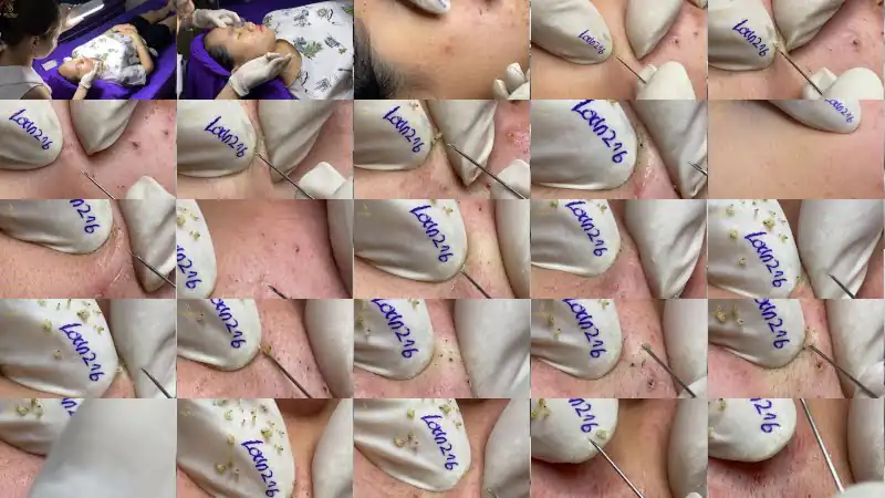 Remove blackheads for girls to puberty (216a) | Loan Nguyen
