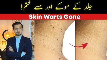 Dr Ahsan: How To Get Rid Of Skin Tags & Warts| Quick Fix| त्वचा के तिल