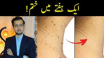 Dr Ahsan: How To Get Rid Of Skin Tags & Warts| Quick Fix| त्वचा के तिल