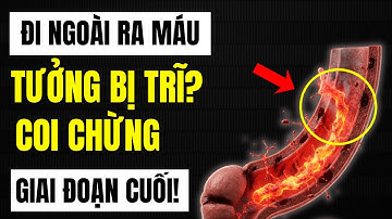 Tưởng Bị TRĨ, Hóa Ra UNG THƯ Đại Tràng Giai Đoạn Cuối! 4 Dấu Hiệu Phân Biệt Polyp Gây Tử Vong