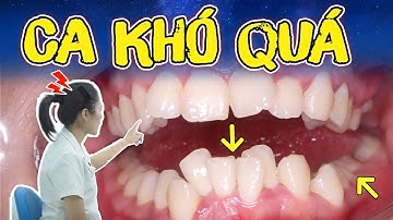 Ca Niềng Răng Hô "Ẵm Trọn" 3 Tình Trạng Khó Nhất Trong Chỉnh Nha - Xem Ngay Kế Hoạch Chi Tiết