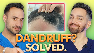 8 Dandruff Hacks that Will Change Your Life | Doctorly’s Guide