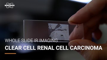 Clear Cell Renal Cell Carcinoma classified by IR Spectral Pathology | Cancer Detection