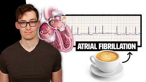 Coffee and Heart Atrial Fibrillation: Counterintuitive New Study