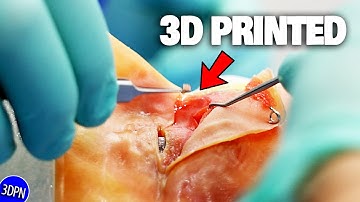 3D Printing for Eye Surgery?