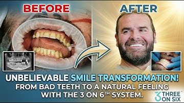 Bad Teeth to a Perfect Smile! The Revolutionary 3 on 6 is Game Changer!