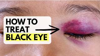 Doctor explains BLACK EYE | Treatment at home and when to seek medical care