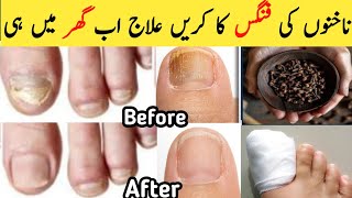 Do you suffer from nail fungus ?You have to do this!*VERY IMPORTANT TIP*| fungal infection treatment