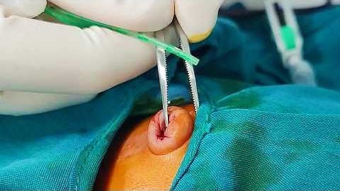 🏥 How Doctors Treat Dangerous Jaundice in Newborns | Exchange Transfusion Tutorial🩸