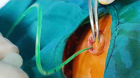 🏥 How Doctors Treat Dangerous Jaundice in Newborns | Exchange Transfusion Tutorial🩸