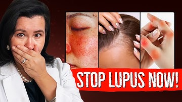 Everything You MUST Know About Lupus in 10 Minutes