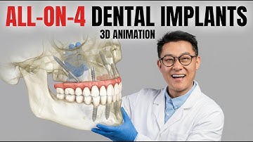 All-on-4 Dental Implant Full Jaw Guide – Step by Step 3D Animation