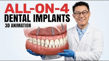 All-on-4 Dental Implant Full Jaw Guide – Step by Step 3D Animation