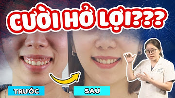 Niềng Răng Có Hết Cười Hở Lợi Không? 30 Giây Kiểm Tra Xem Bạn Niềng Có Hết Cười Hở Lợi Không!